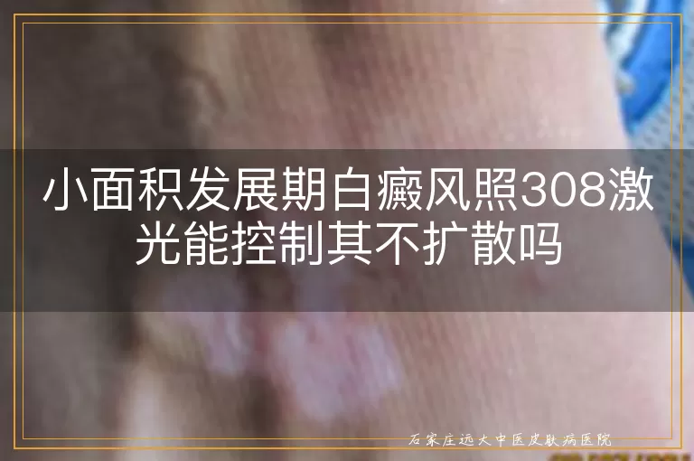 小面积发展期白癜风照308激光能控制其不扩散吗