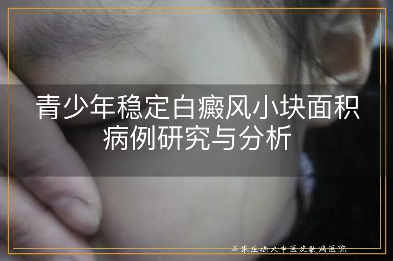 青少年稳定白癜风小块面积病例研究与分析