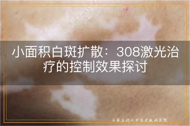 小面积白斑扩散：308激光治疗的控制效果探讨
