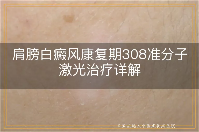 肩膀白癜风康复期308准分子激光治疗详解