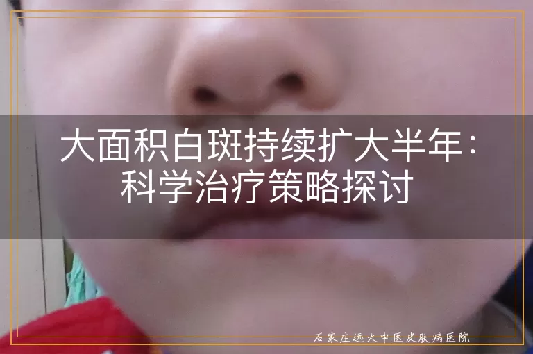大面积白斑持续扩大半年：科学治疗策略探讨