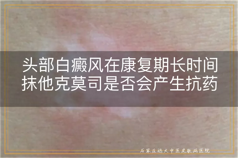 头部白癜风在康复期长时间抹他克莫司是否会产生抗药性