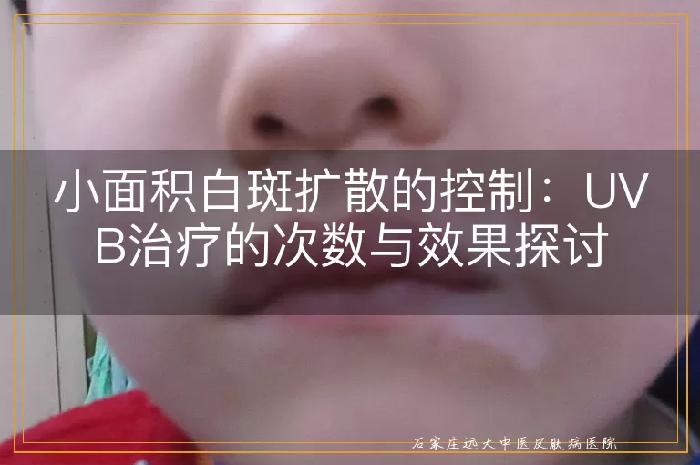 小面积白斑扩散的控制：UVB治疗的次数与效果探讨