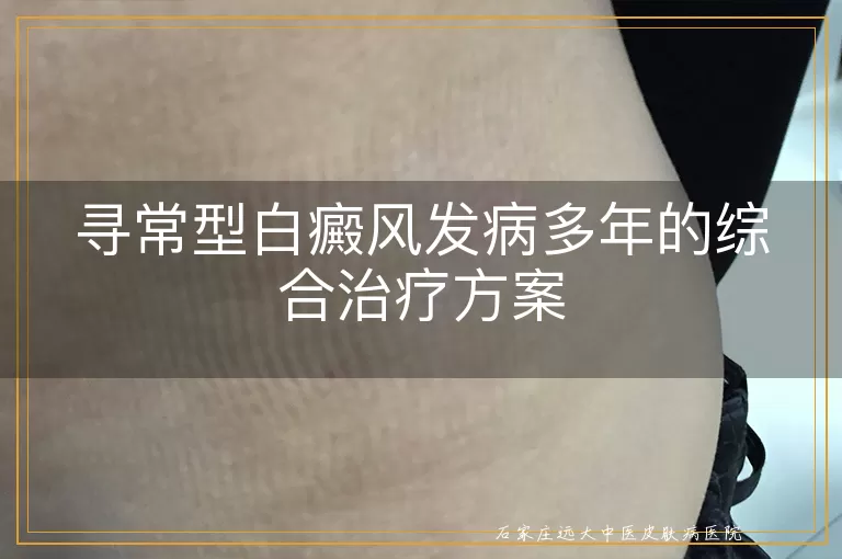 寻常型白癜风发病多年的综合治疗方案