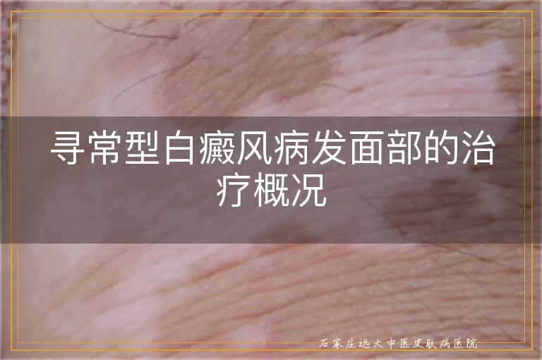 寻常型白癜风病发面部的治疗概况