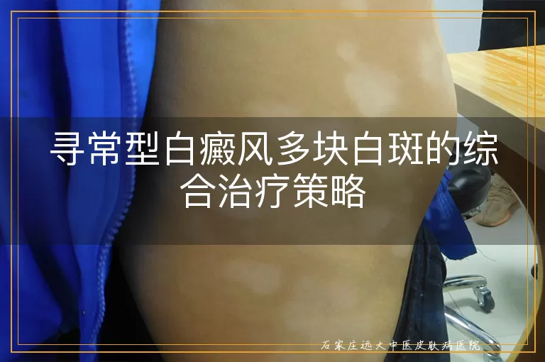 寻常型白癜风多块白斑的综合治疗策略