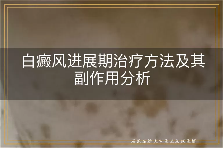白癜风进展期治疗方法及其副作用分析