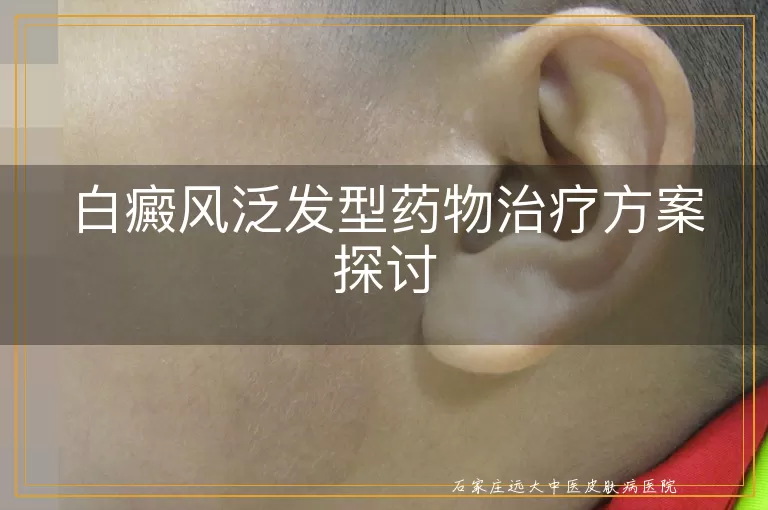 白癜风泛发型药物治疗方案探讨