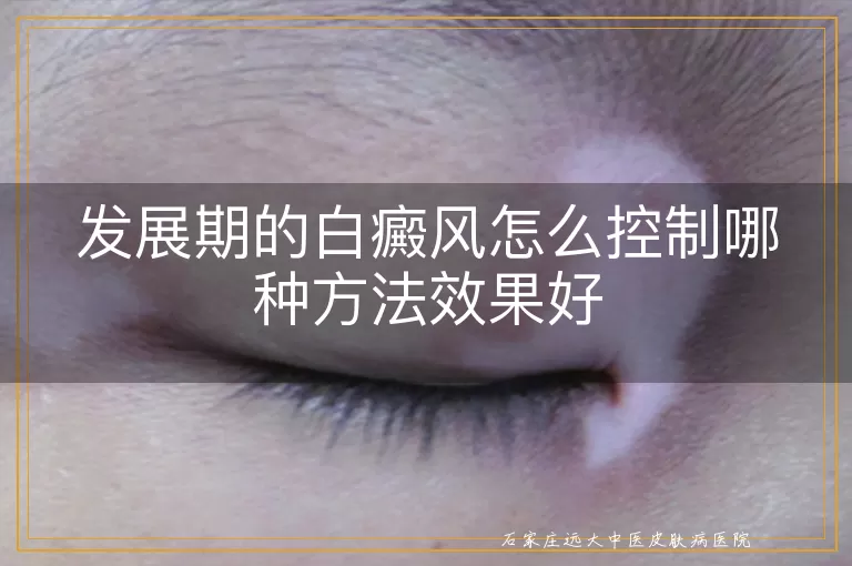 发展期的白癜风怎么控制哪种方法效果好