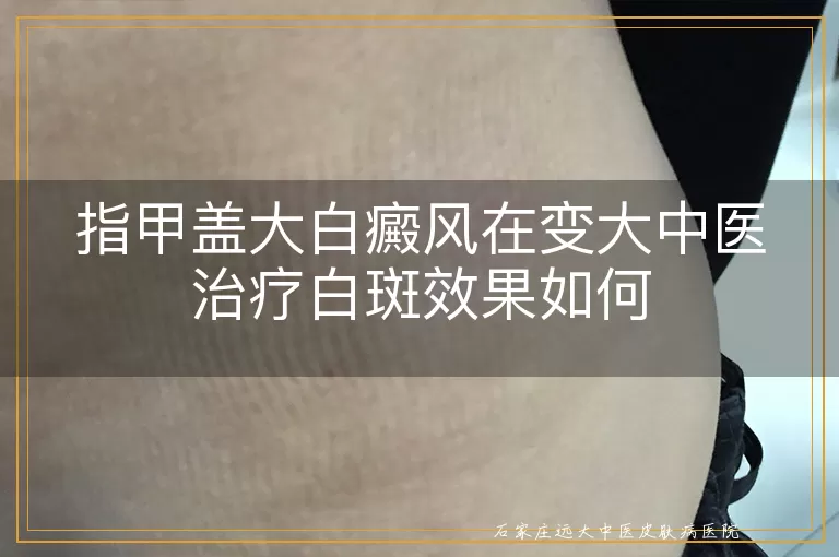 指甲盖大白癜风在变大中医治疗白斑效果如何