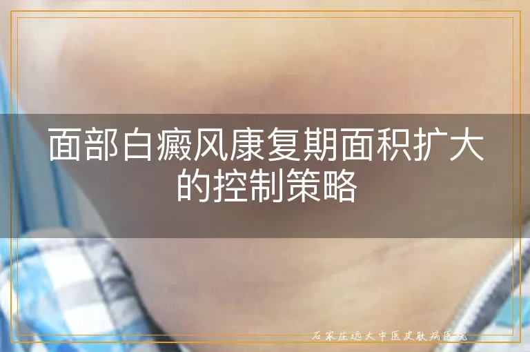 面部白癜风康复期面积扩大的控制策略