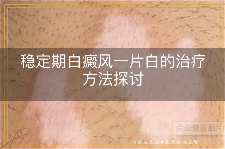 稳定期白癜风一片白的治疗方法探讨