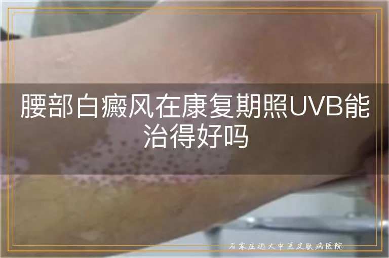 腰部白癜风在康复期照UVB能治得好吗