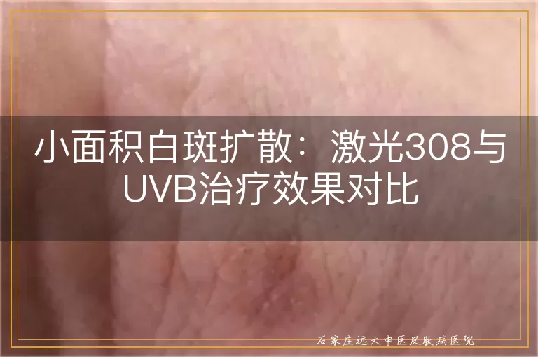 小面积白斑扩散：激光308与UVB治疗效果对比