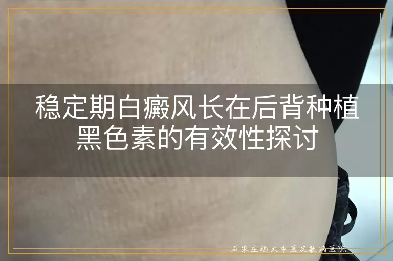 稳定期白癜风长在后背种植黑色素的有效性探讨