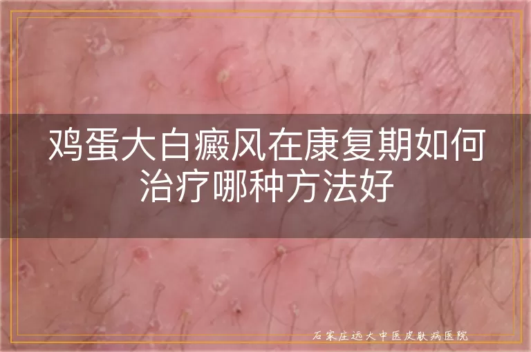 鸡蛋大白癜风在康复期如何治疗哪种方法好