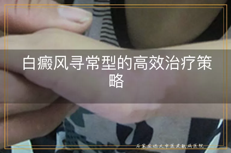 白癜风寻常型的高效治疗策略