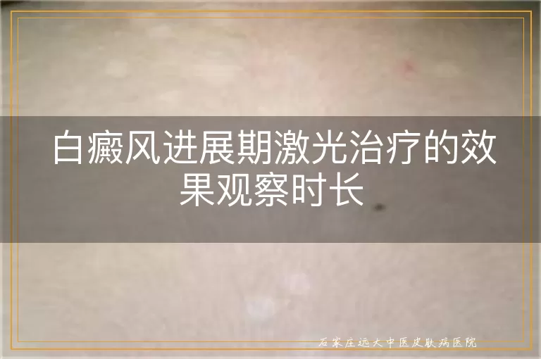 白癜风进展期激光治疗的效果观察时长