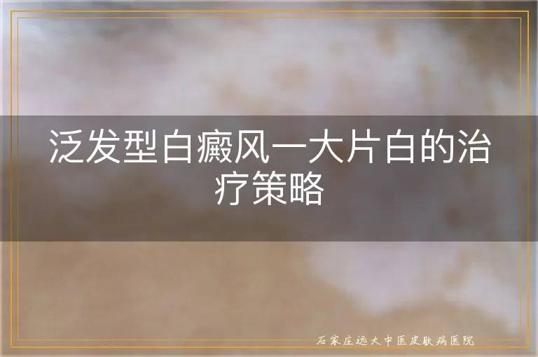 泛发型白癜风一大片白的治疗策略