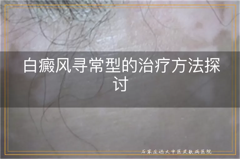 白癜风寻常型的治疗方法探讨