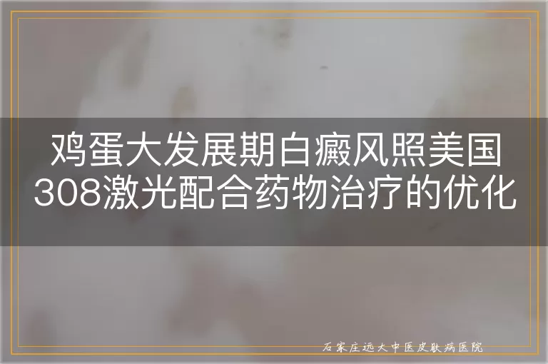 鸡蛋大发展期白癜风照美国308激光配合药物治疗的优化选择