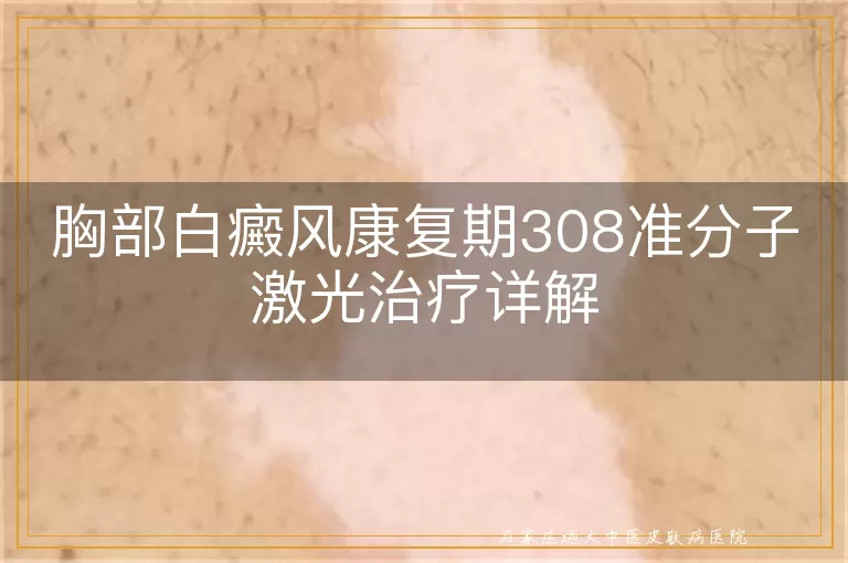胸部白癜风康复期308准分子激光治疗详解