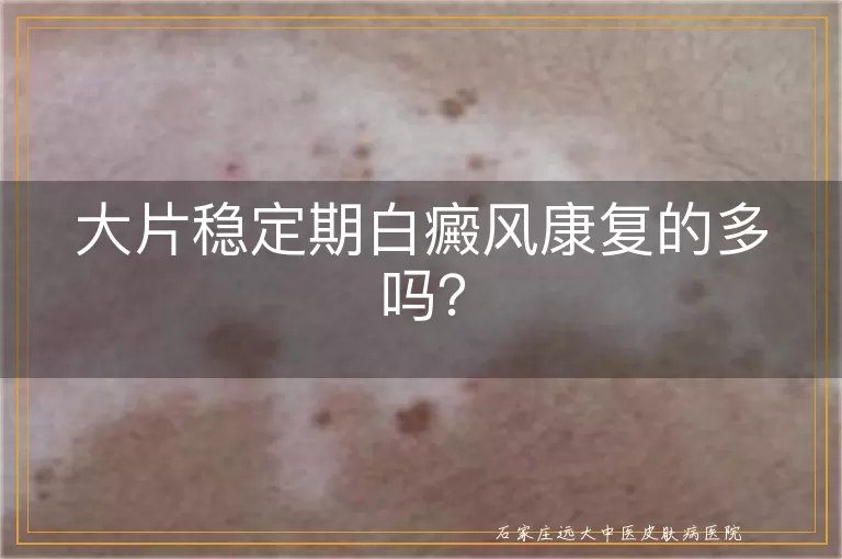 大片稳定期白癜风康复的多吗？