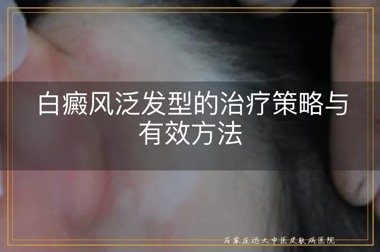 白癜风泛发型的治疗策略与有效方法