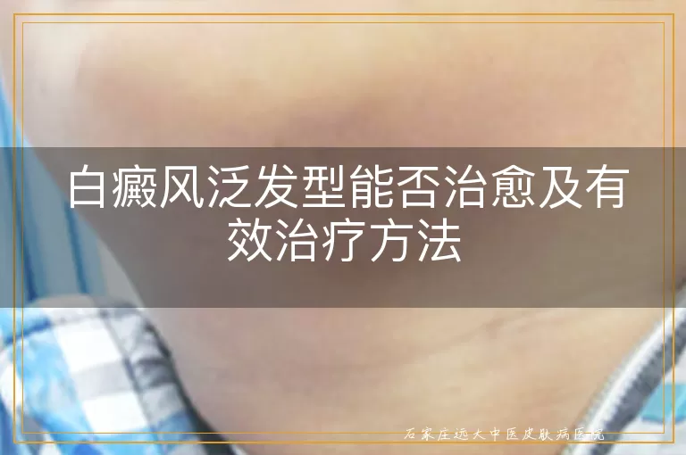 白癜风泛发型能否治愈及有效治疗方法