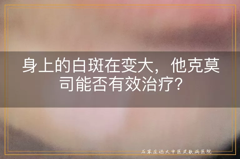 身上的白斑在变大，他克莫司能否有效治疗？