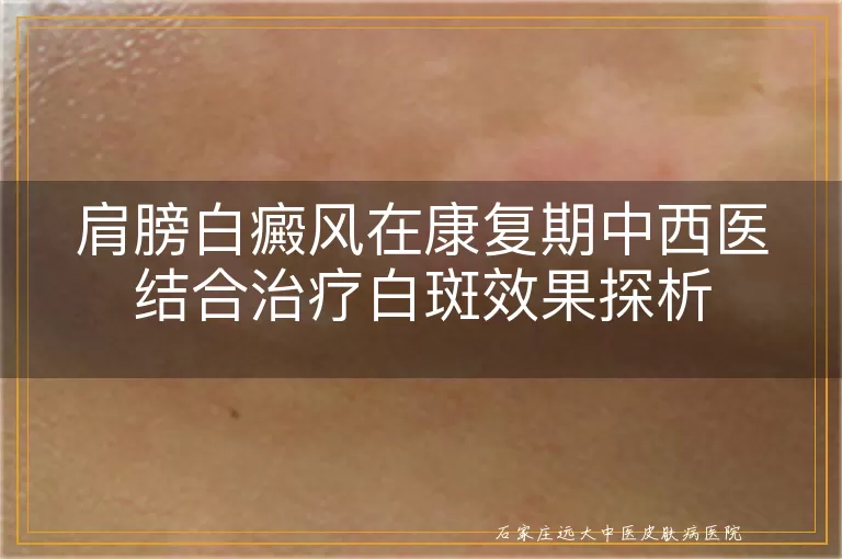 肩膀白癜风在康复期中西医结合治疗白斑效果探析