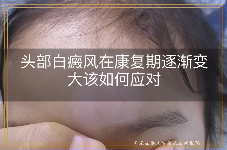 头部白癜风在康复期逐渐变大该如何应对
