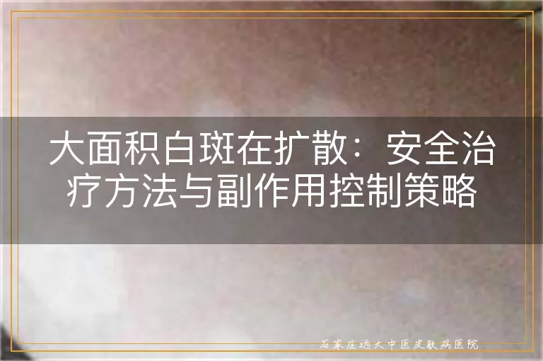 大面积白斑在扩散：安全治疗方法与副作用控制策略