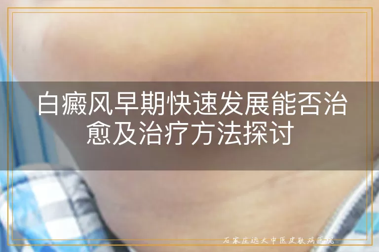 白癜风早期快速发展能否治愈及治疗方法探讨