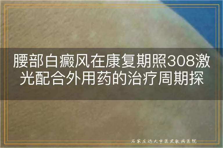 腰部白癜风在康复期照308激光配合外用药的治疗周期探讨