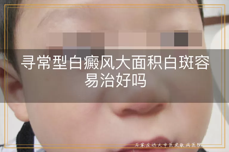 寻常型白癜风大面积白斑容易治好吗