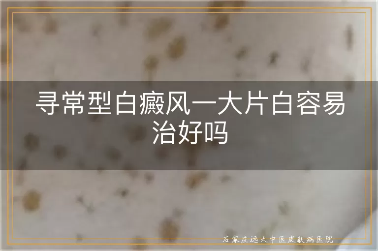 寻常型白癜风一大片白容易治好吗