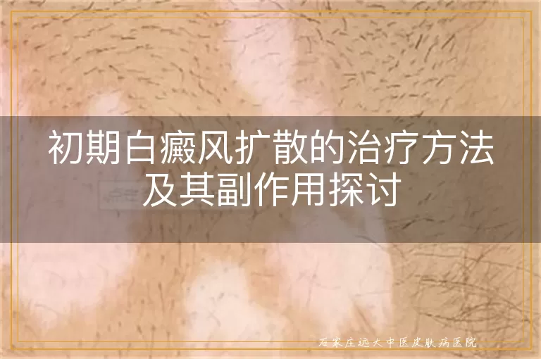 初期白癜风扩散的治疗方法及其副作用探讨