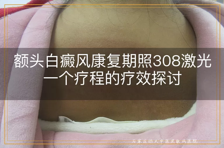 额头白癜风康复期照308激光一个疗程的疗效探讨