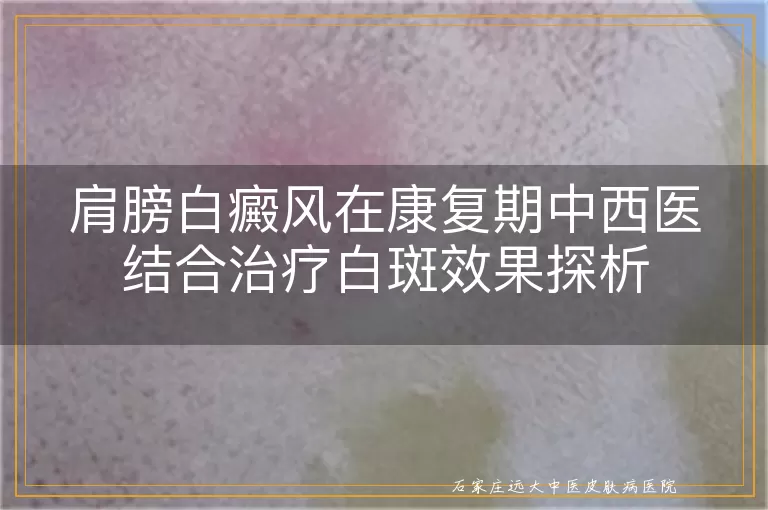 肩膀白癜风在康复期中西医结合治疗白斑效果探析