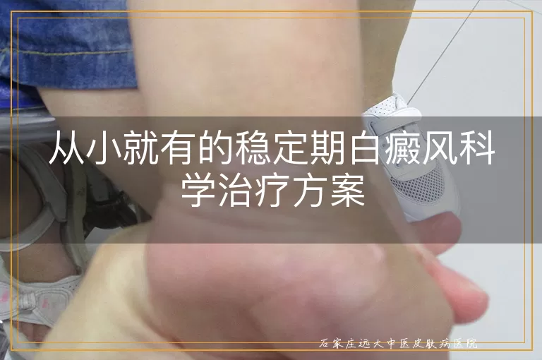 从小就有的稳定期白癜风科学治疗方案