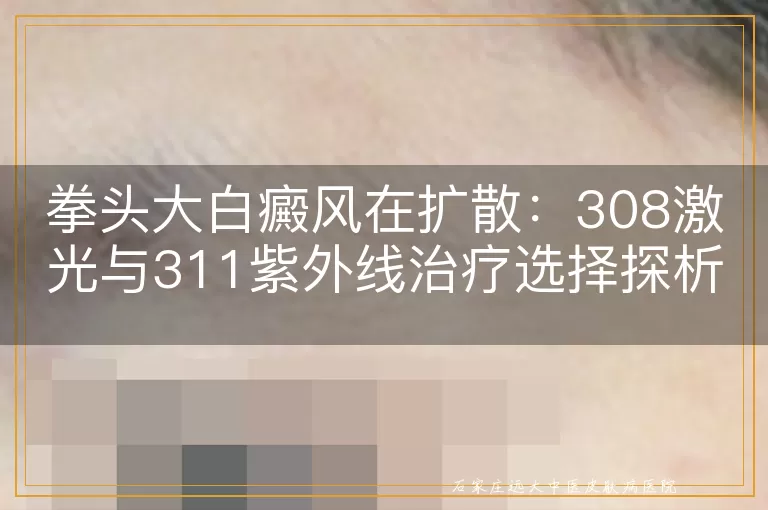 拳头大白癜风在扩散：308激光与311紫外线治疗选择探析