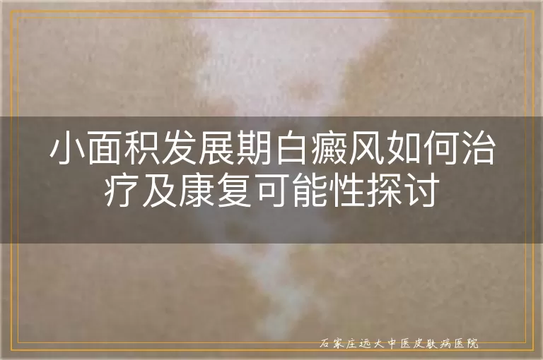 小面积发展期白癜风如何治疗及康复可能性探讨