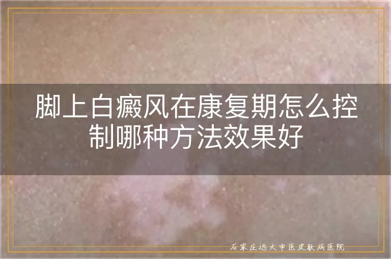 脚上白癜风在康复期怎么控制哪种方法效果好