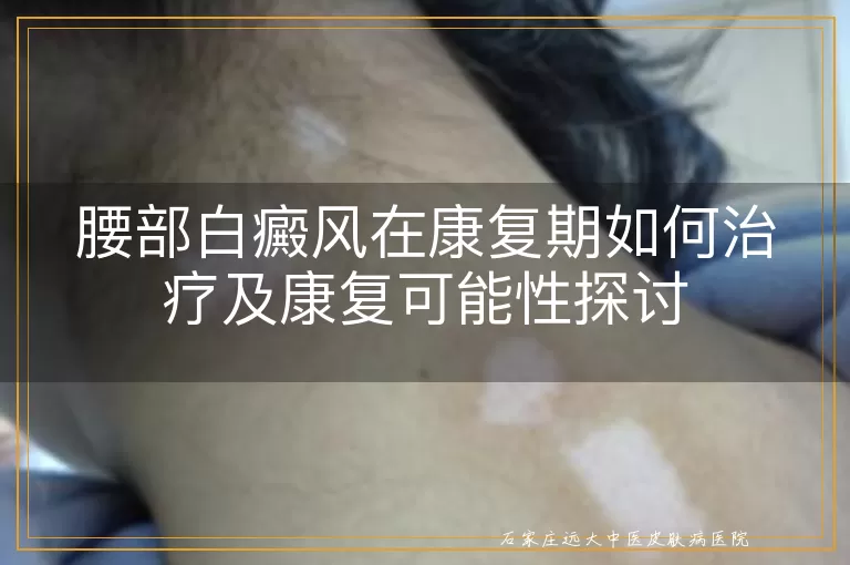 腰部白癜风在康复期如何治疗及康复可能性探讨
