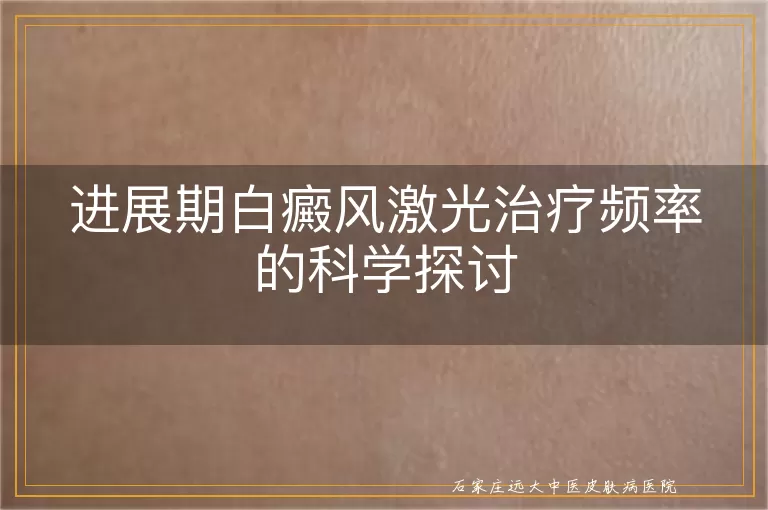 进展期白癜风激光治疗频率的科学探讨