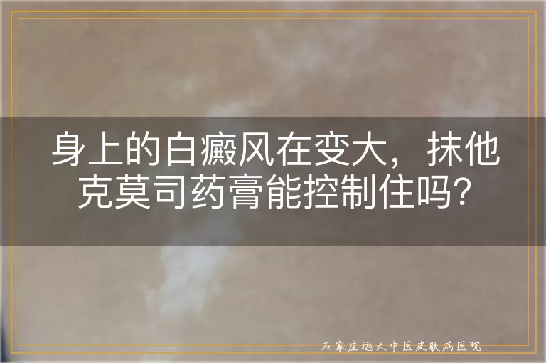 身上的白癜风在变大，抹他克莫司药膏能控制住吗？