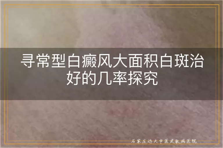 寻常型白癜风大面积白斑治好的几率探究