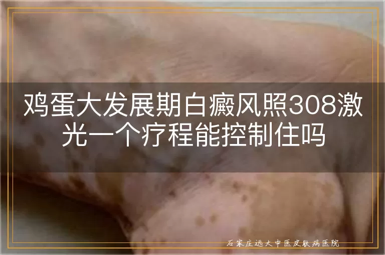 鸡蛋大发展期白癜风照308激光一个疗程能控制住吗