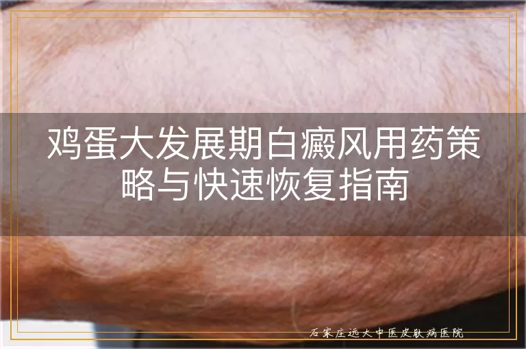 鸡蛋大发展期白癜风用药策略与快速恢复指南